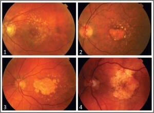 Degeneração Macular